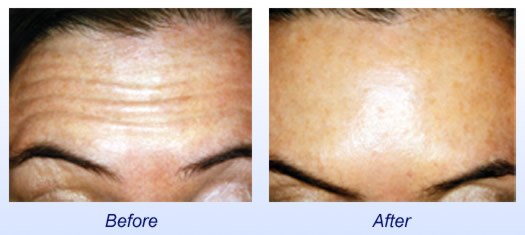 Botox Cosmetic  Before & After 1