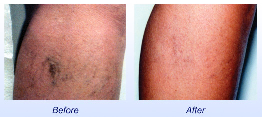 Laser/IPL Vein Treatment  Before & After 2