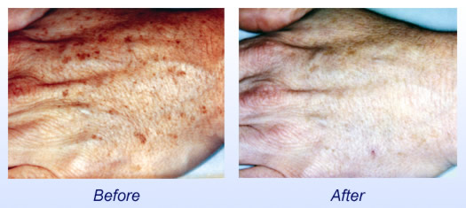 Microdermabrasionl Before & After 2