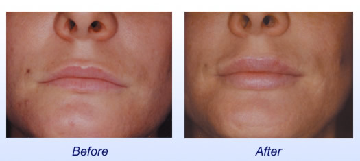 Botox Cosmetic  Before & After 1