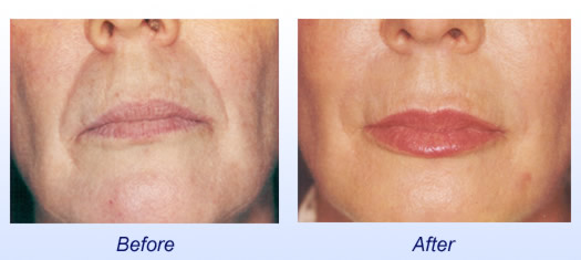 Botox Cosmetic  Before & After 2