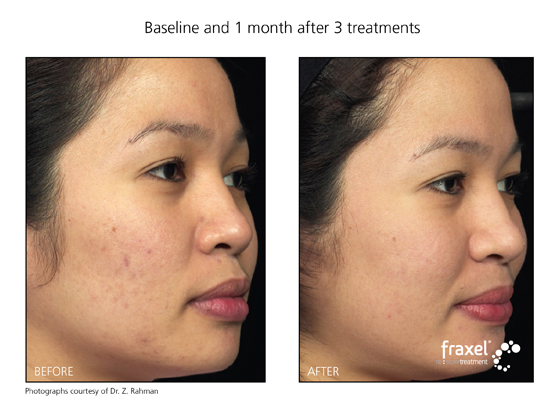 Fraxel Before & After 1