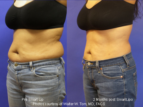 SmartLipo Before & After 3