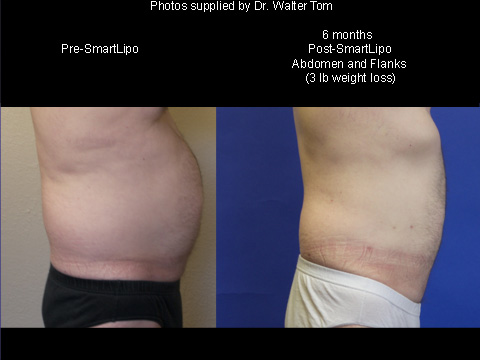 SmartLipo Before & After 7
