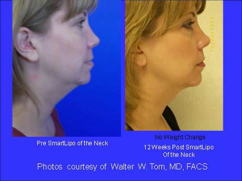 SmartLipo Before & After 9